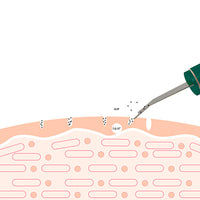 Ultrasonic skin spatula, view 7